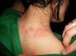 bed-bug-bites