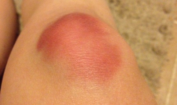 bruised knees from doing burpees at Crossfit